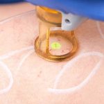 Lazerle Varis Tedavisi Nasıl Yapılır? 2026 Güncel Yöntemler ve Hasta Rehberi - Prof. Dr. Haşmet Bardakçı
